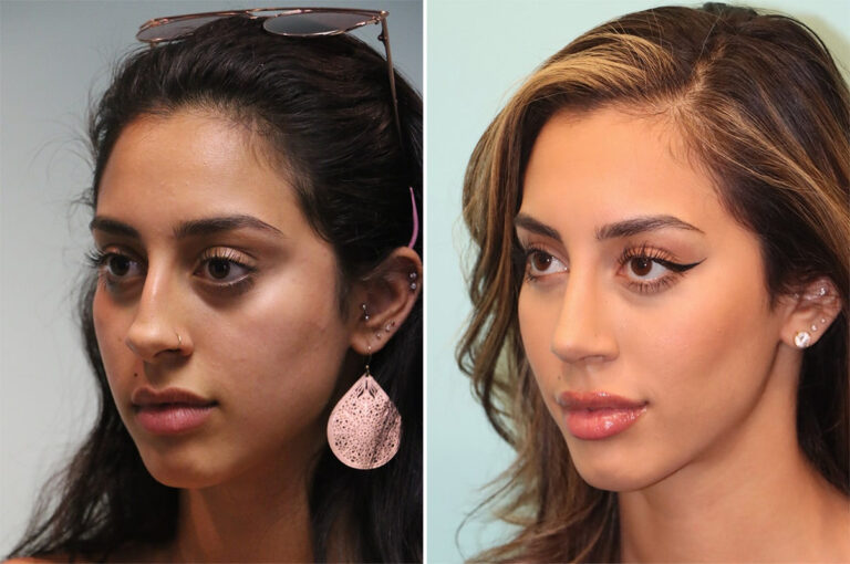 Before and after rhinoplasty by Dr. Shervin Naderi: crooked nose with a hump
