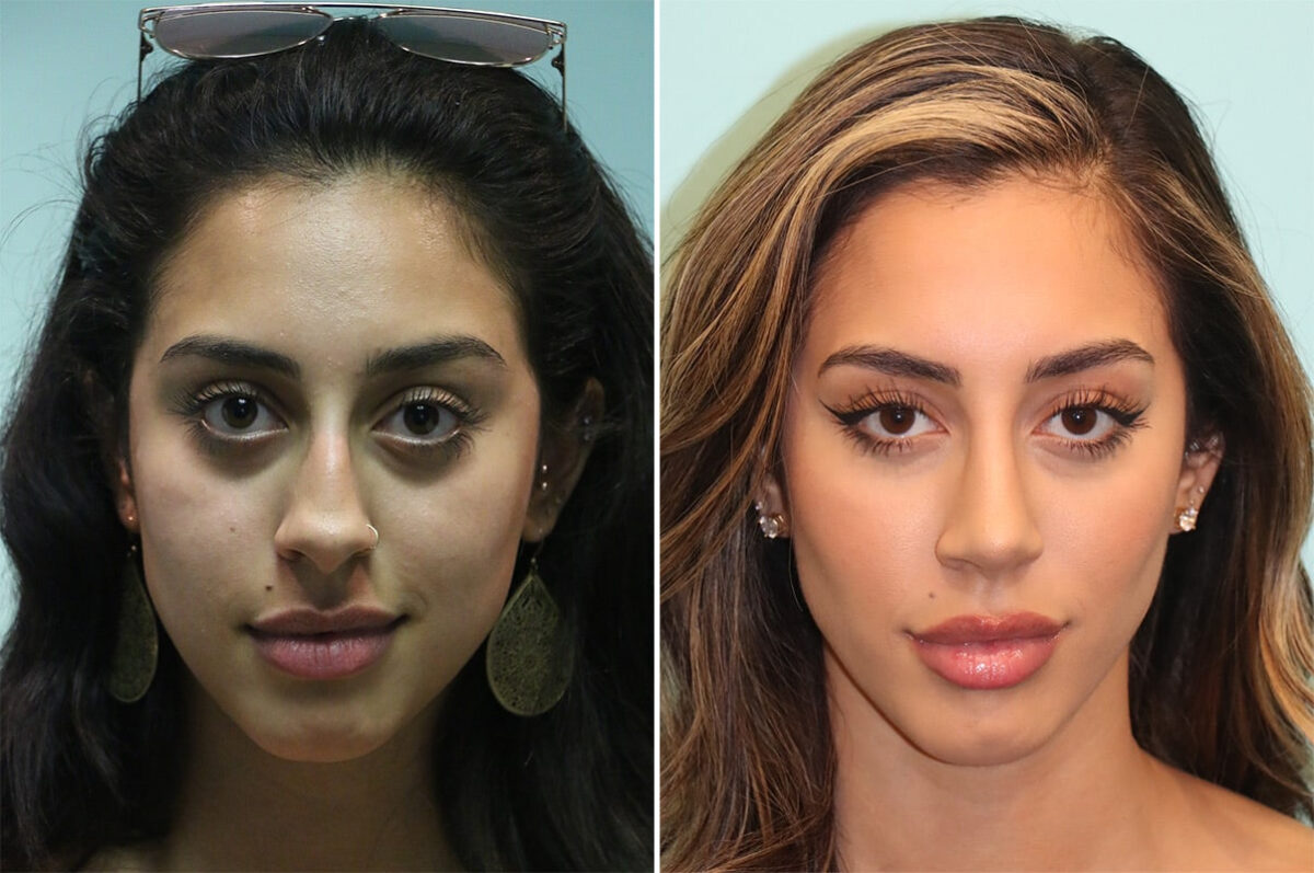 Before and after Rhinoplasty by Dr. Shervin Naderi, Patient 36618