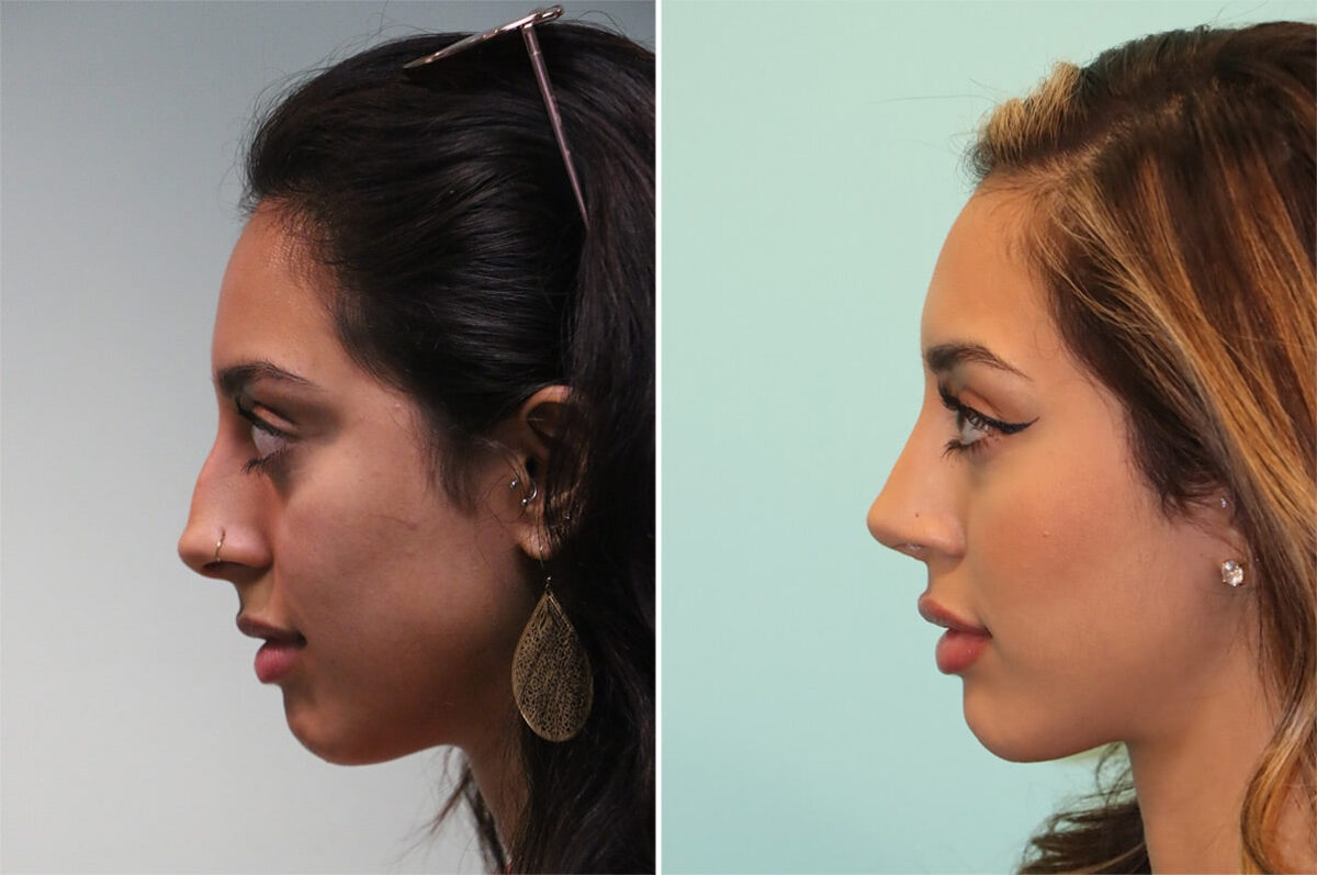Before and after Rhinoplasty by Dr. Shervin Naderi, Patient 36618