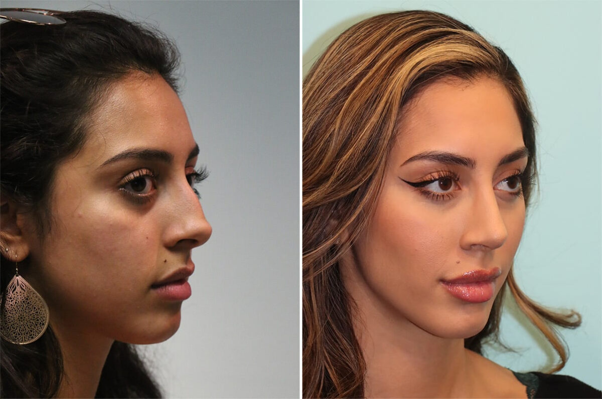 Before and after Rhinoplasty by Dr. Shervin Naderi, Patient 36618