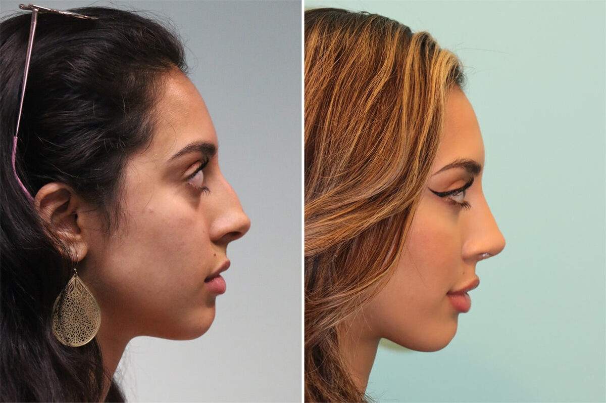 Before and after Rhinoplasty by Dr. Shervin Naderi, Patient 36618