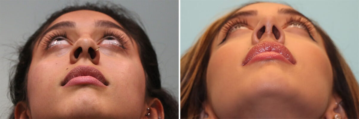 Before and after Rhinoplasty by Dr. Shervin Naderi, Patient 36618