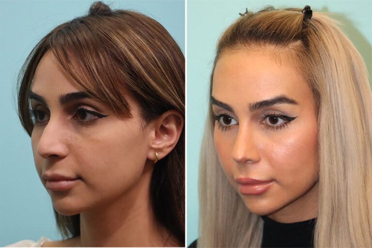 Before and after rhinoplasty by Dr. Shervin Naderi: a smaller nose