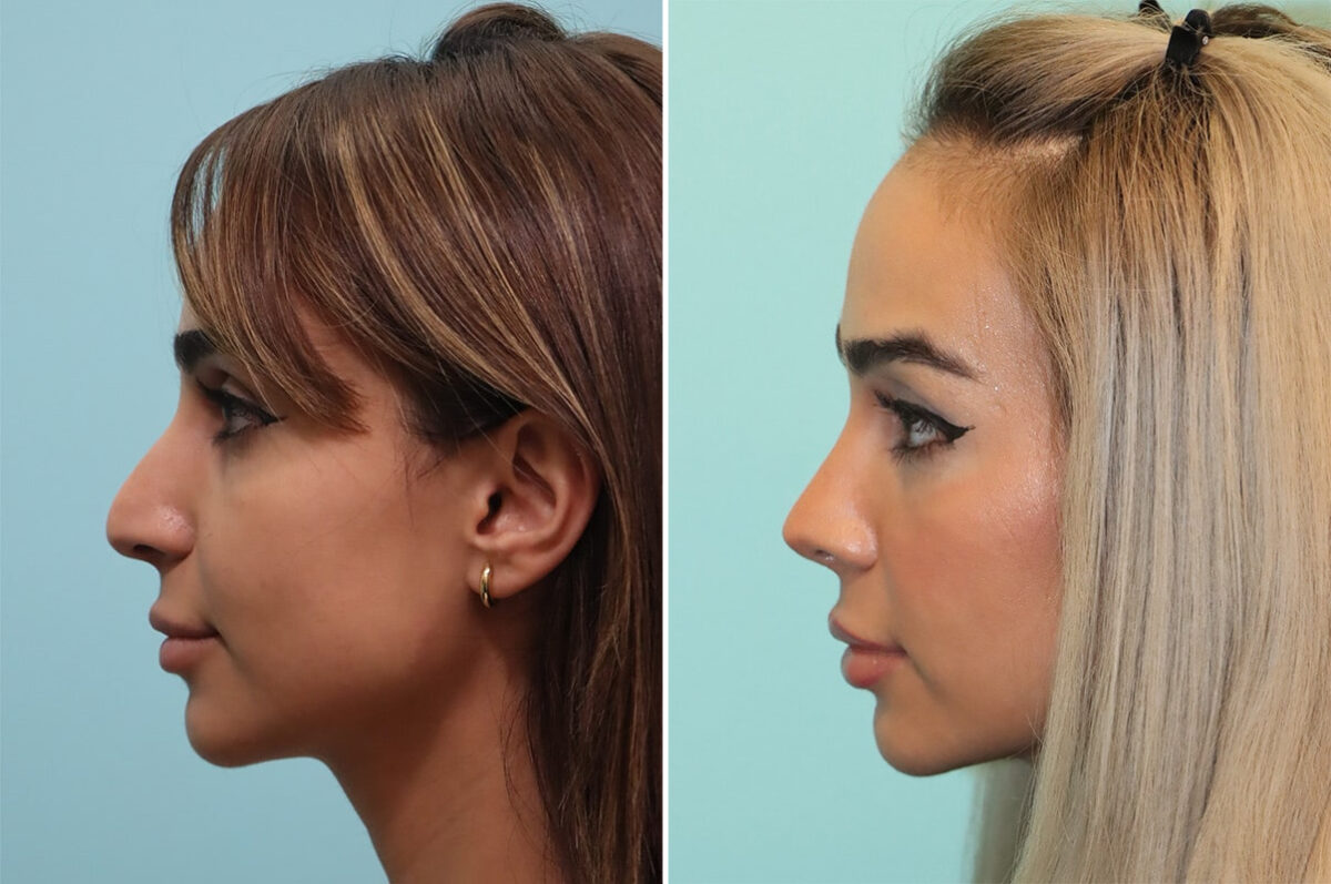 Before and after Rhinoplasty by Dr. Shervin Naderi, Patient 36680