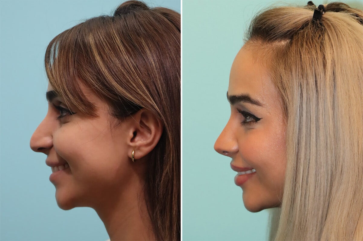 Before and after Rhinoplasty by Dr. Shervin Naderi, Patient 36680