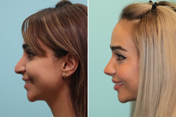 Before and after Rhinoplasty by Dr. Shervin Naderi, Patient 36680