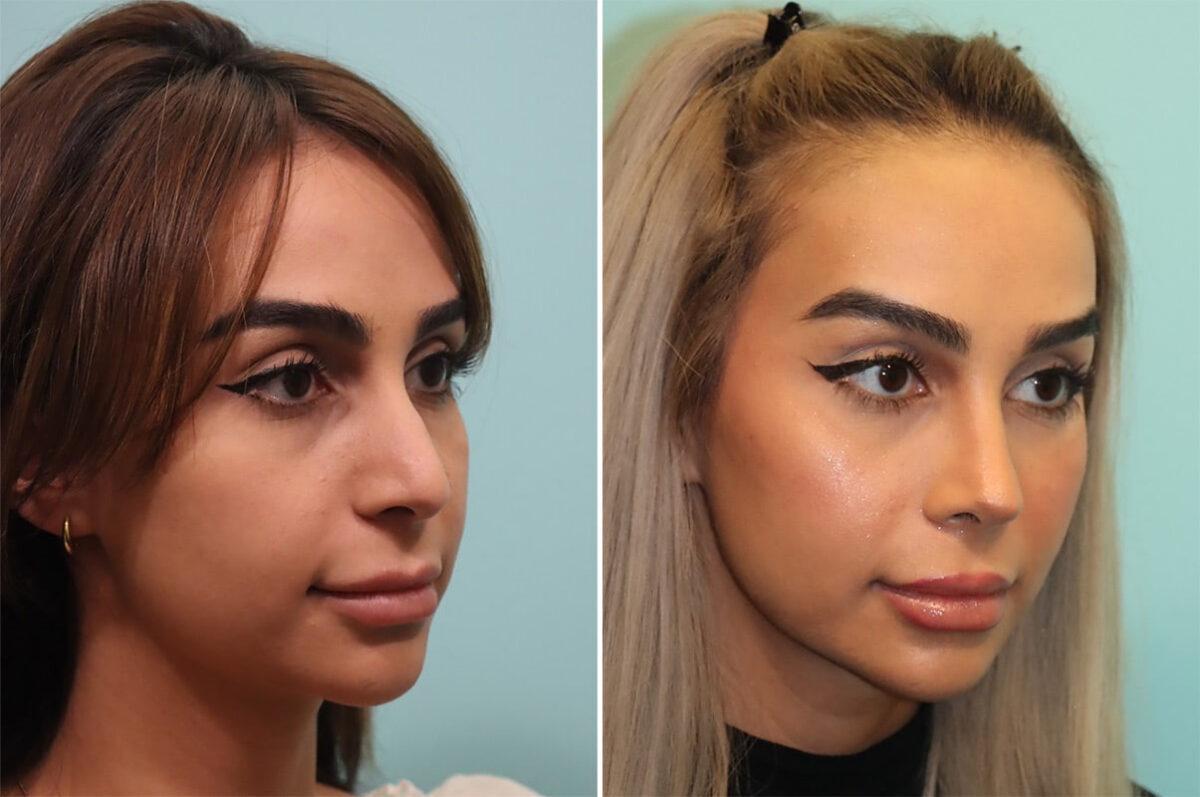 Before and after Rhinoplasty by Dr. Shervin Naderi, Patient 36680