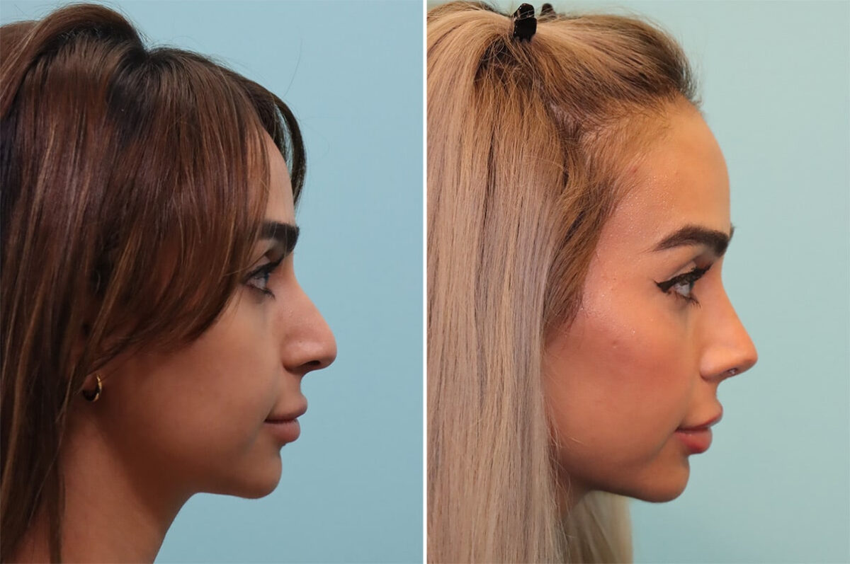 Before and after Rhinoplasty by Dr. Shervin Naderi, Patient 36680