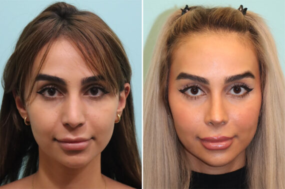 Before and after Rhinoplasty by Dr. Shervin Naderi, Patient 36680
