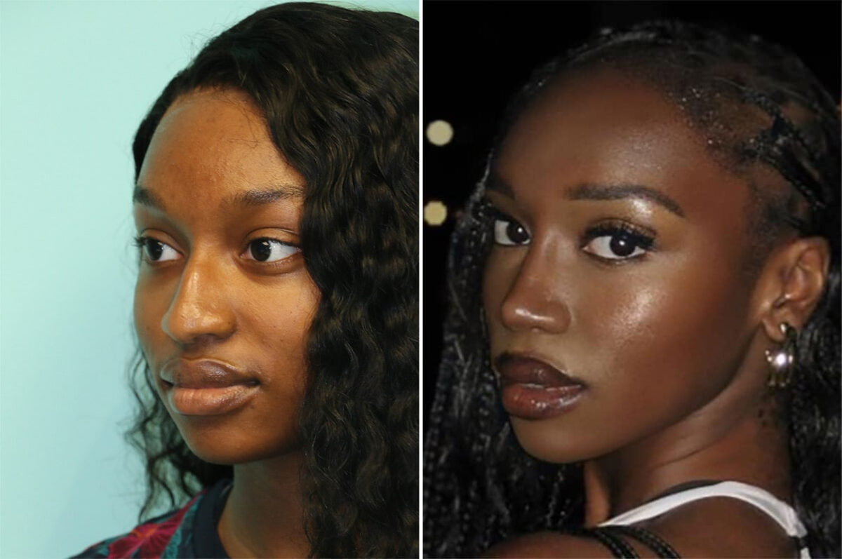 Before and after Rhinoplasty by Dr. Shervin Naderi, Patient 36695