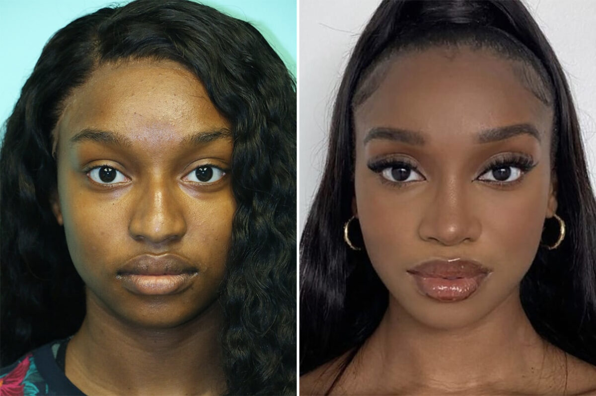 Before and after Rhinoplasty by Dr. Shervin Naderi, Patient 36695