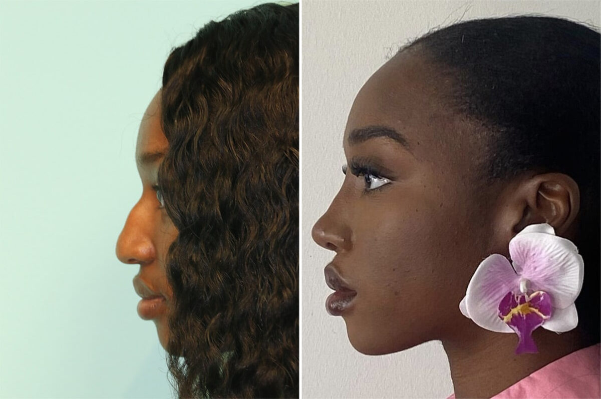Before and after Rhinoplasty by Dr. Shervin Naderi, Patient 36695