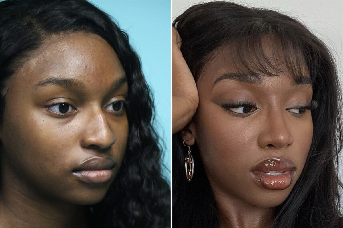 Before and after Rhinoplasty by Dr. Shervin Naderi, Patient 36695