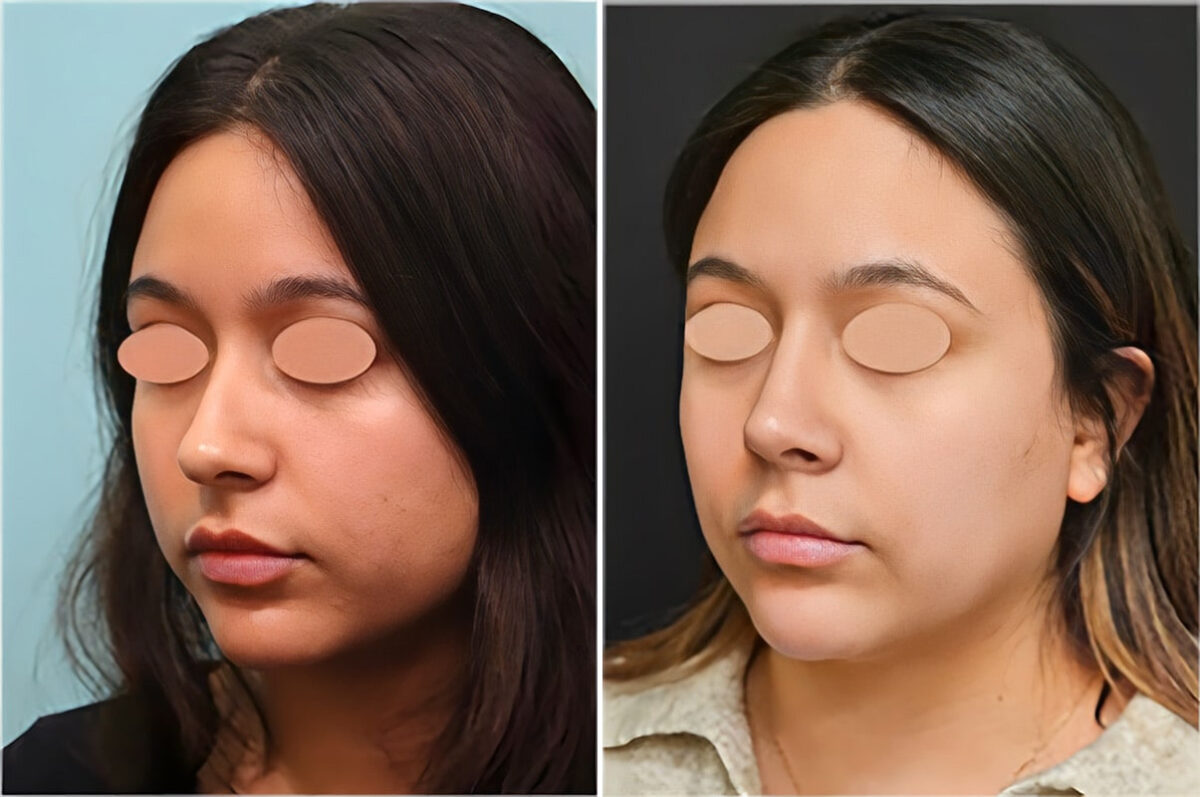 Before and after Rhinoplasty by Dr. Shervin Naderi, Patient 36752