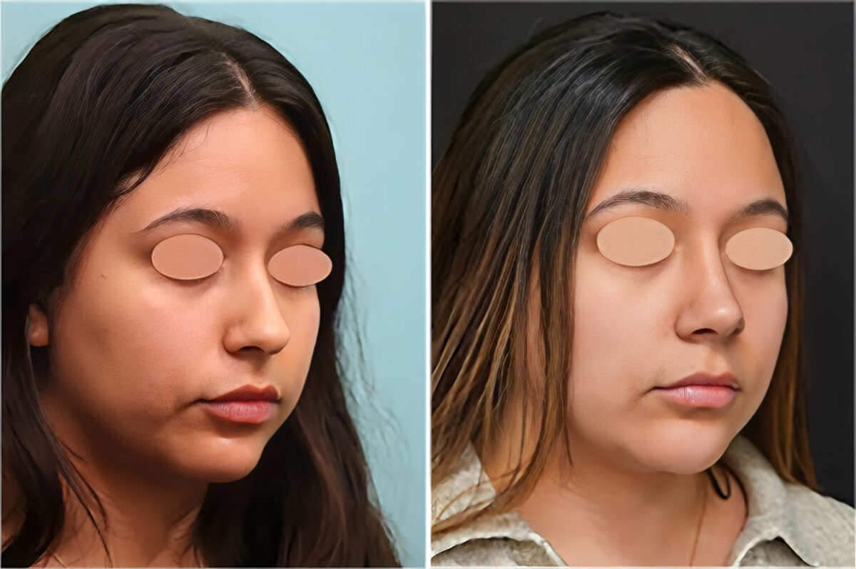 Before and after Rhinoplasty by Dr. Shervin Naderi, Patient 36752