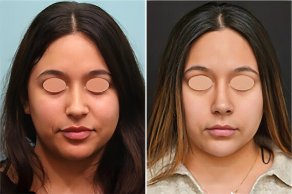 Before and after Rhinoplasty by Dr. Shervin Naderi, Patient 36752