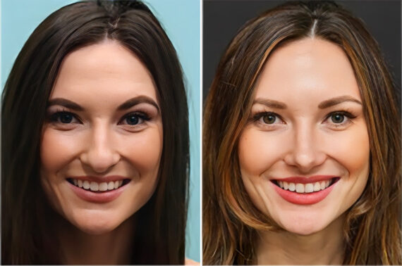 Before and after Rhinoplasty by Dr. Shervin Naderi, Patient 36756