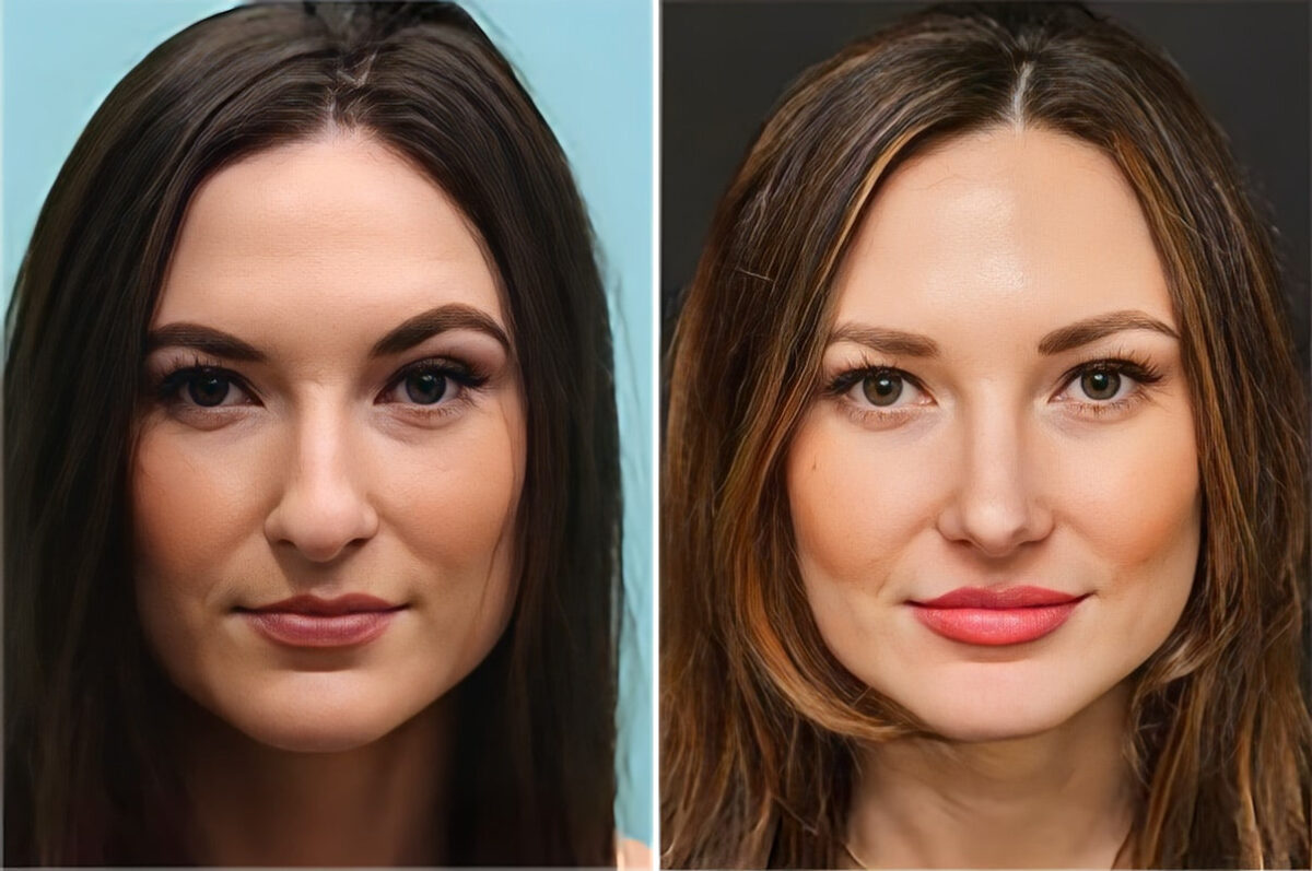 Before and after Rhinoplasty by Dr. Shervin Naderi, Patient 36756