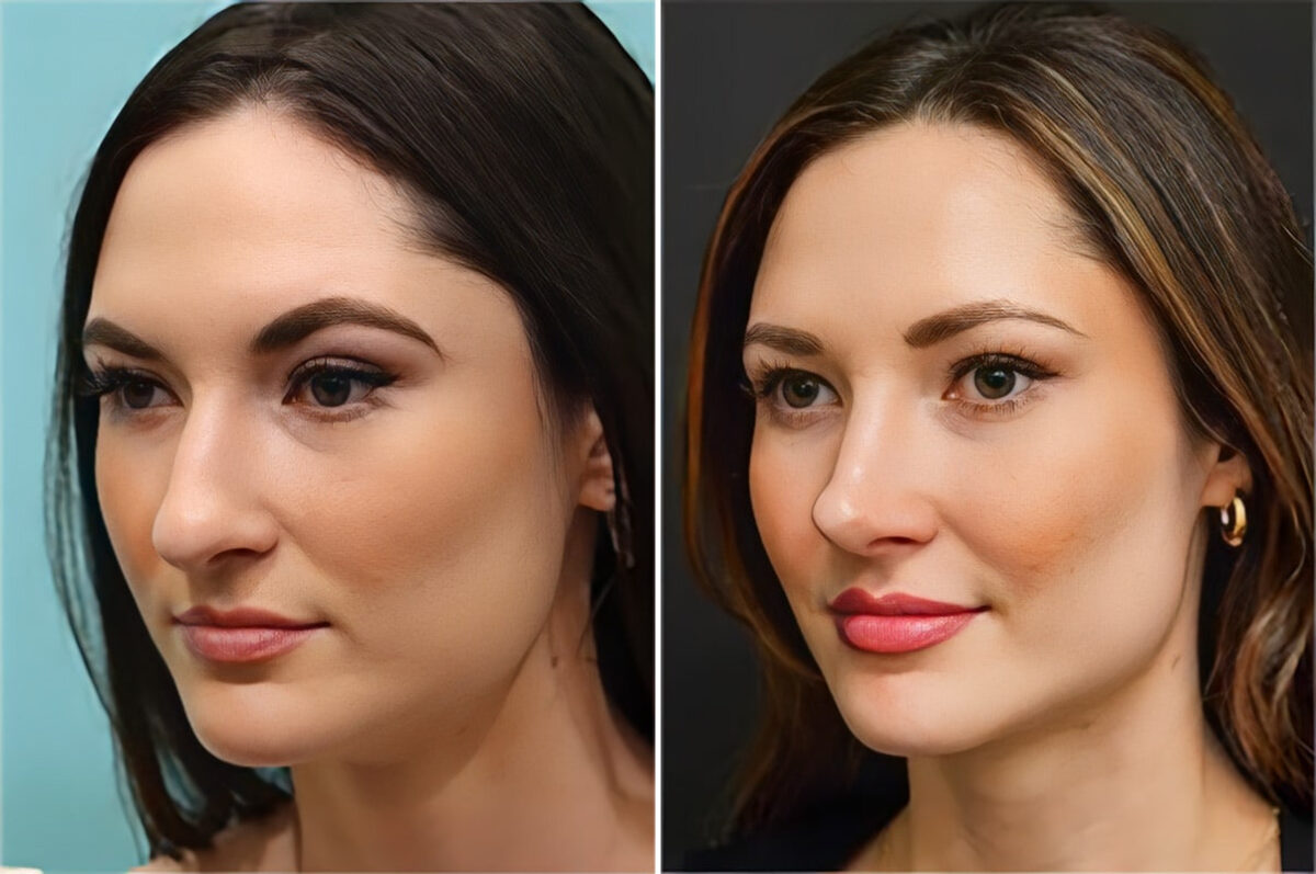 Before and after Rhinoplasty by Dr. Shervin Naderi, Patient 36756