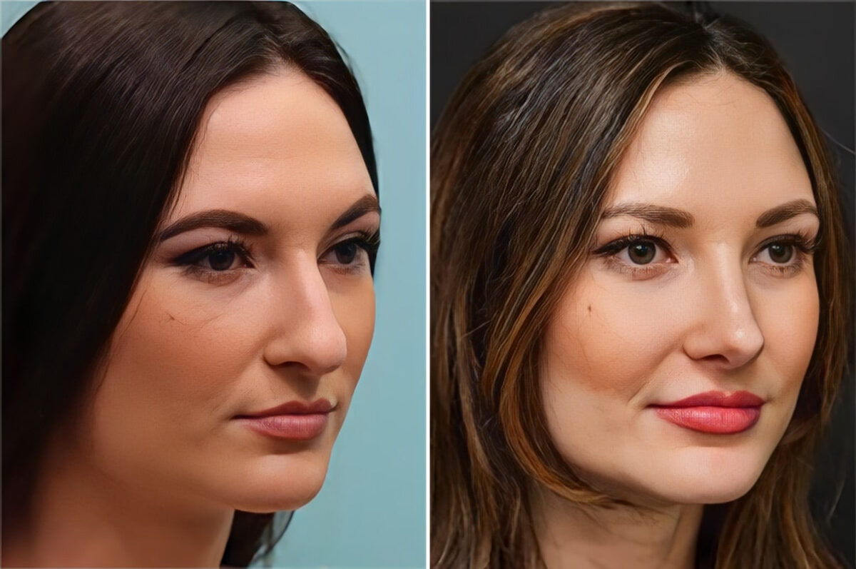 Before and after Rhinoplasty by Dr. Shervin Naderi, Patient 36756