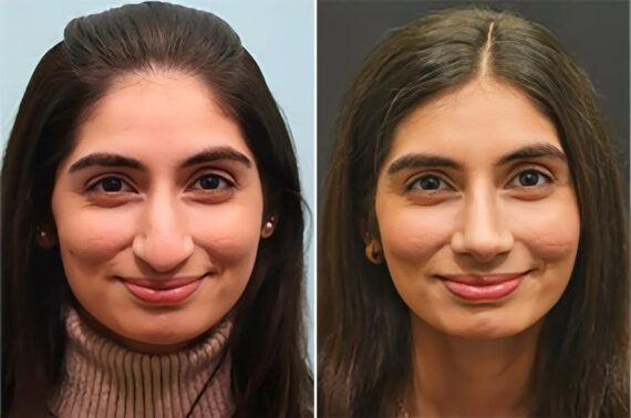 Before and after Rhinoplasty by Dr. Shervin Naderi, Patient 36762