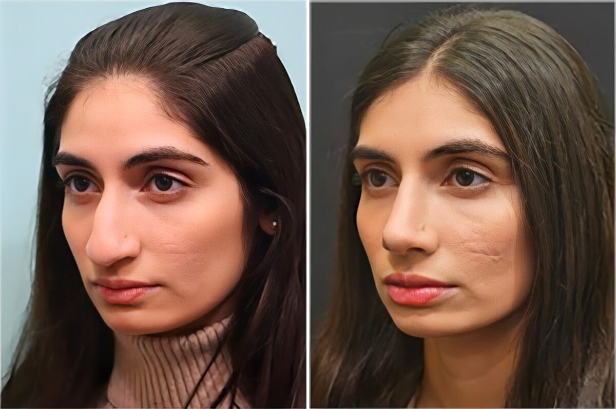Before and after Rhinoplasty by Dr. Shervin Naderi, Patient 36762