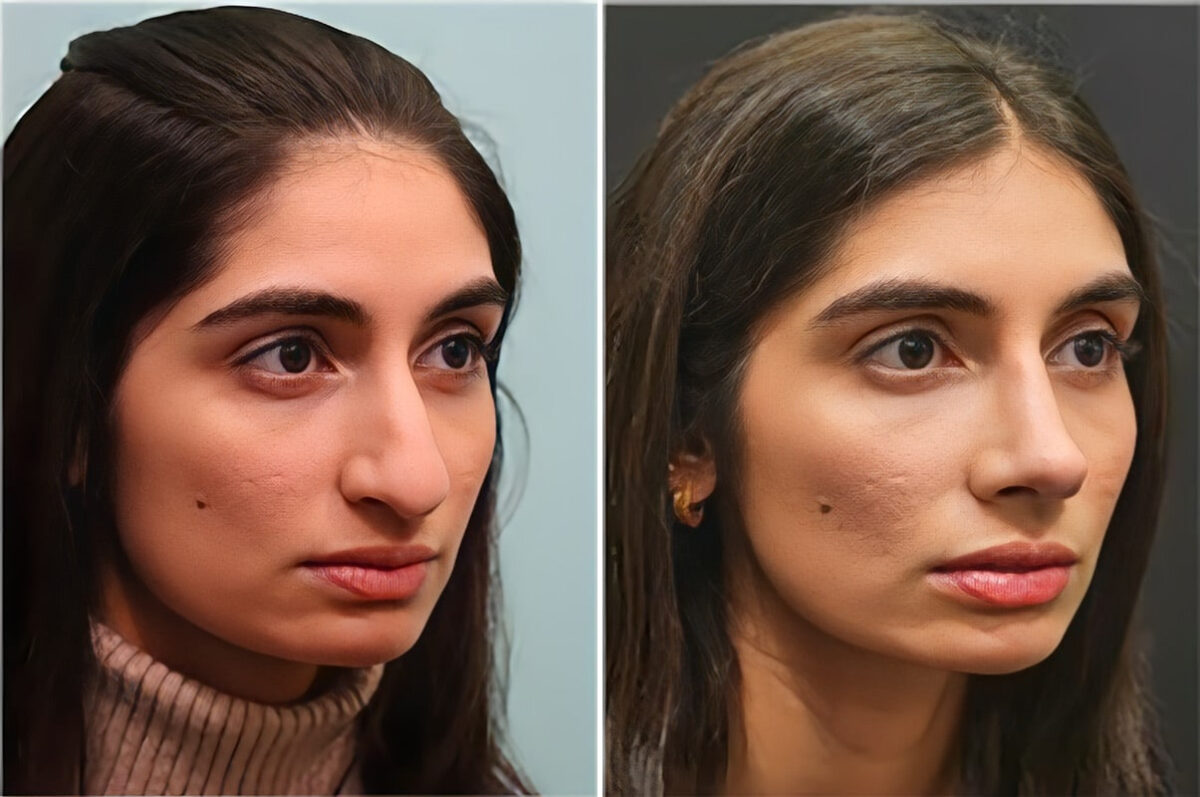 Before and after Rhinoplasty by Dr. Shervin Naderi, Patient 36762