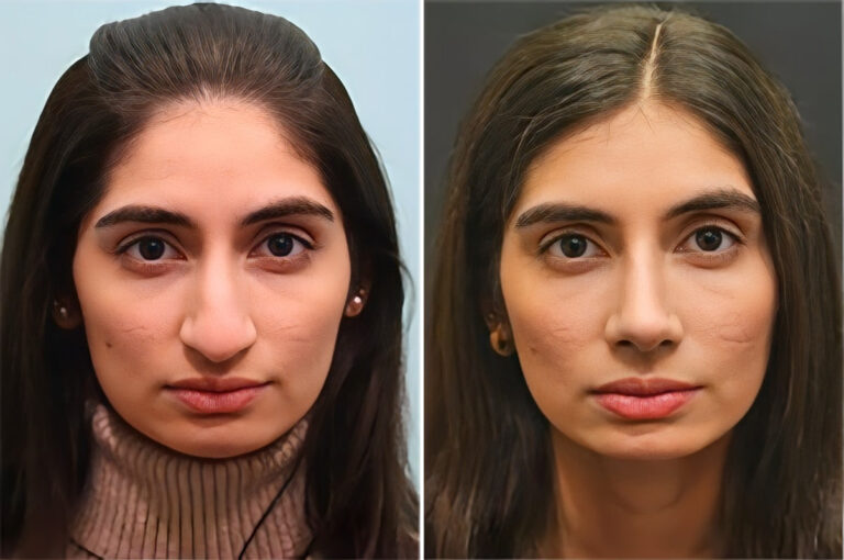 Before and after rhinoplasty by Dr. Shervin Naderi: droopy tip