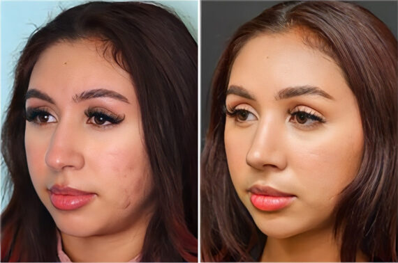Before and after Rhinoplasty by Dr. Shervin Naderi, Patient 36767