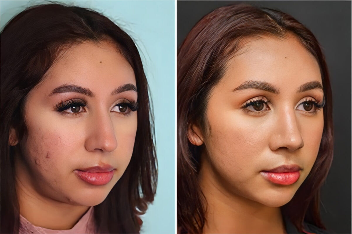 Before and after Rhinoplasty by Dr. Shervin Naderi, Patient 36767