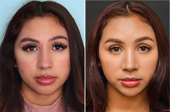Before and after Rhinoplasty by Dr. Shervin Naderi, Patient 36767