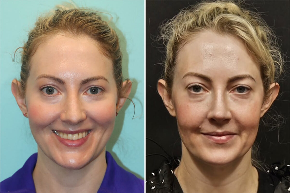 Before and after Rhinoplasty by Dr. Shervin Naderi, Patient 36771