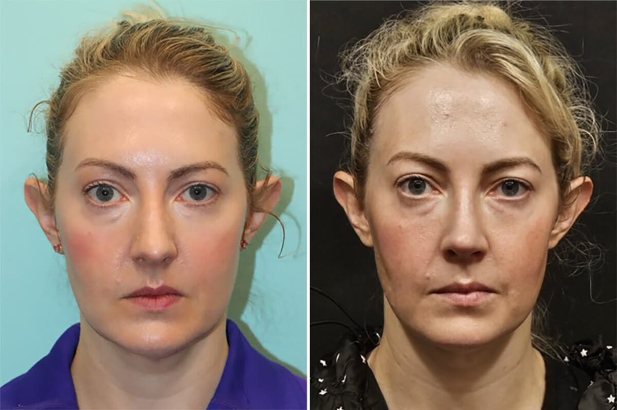 Before and after Rhinoplasty by Dr. Shervin Naderi, Patient 36771