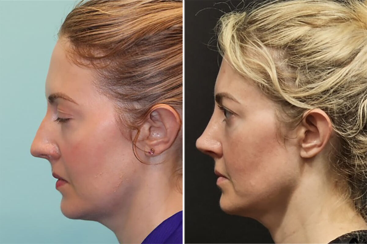 Before and after Rhinoplasty by Dr. Shervin Naderi, Patient 36771