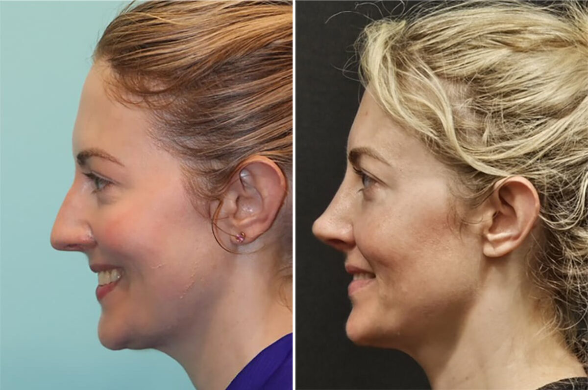 Before and after Rhinoplasty by Dr. Shervin Naderi, Patient 36771