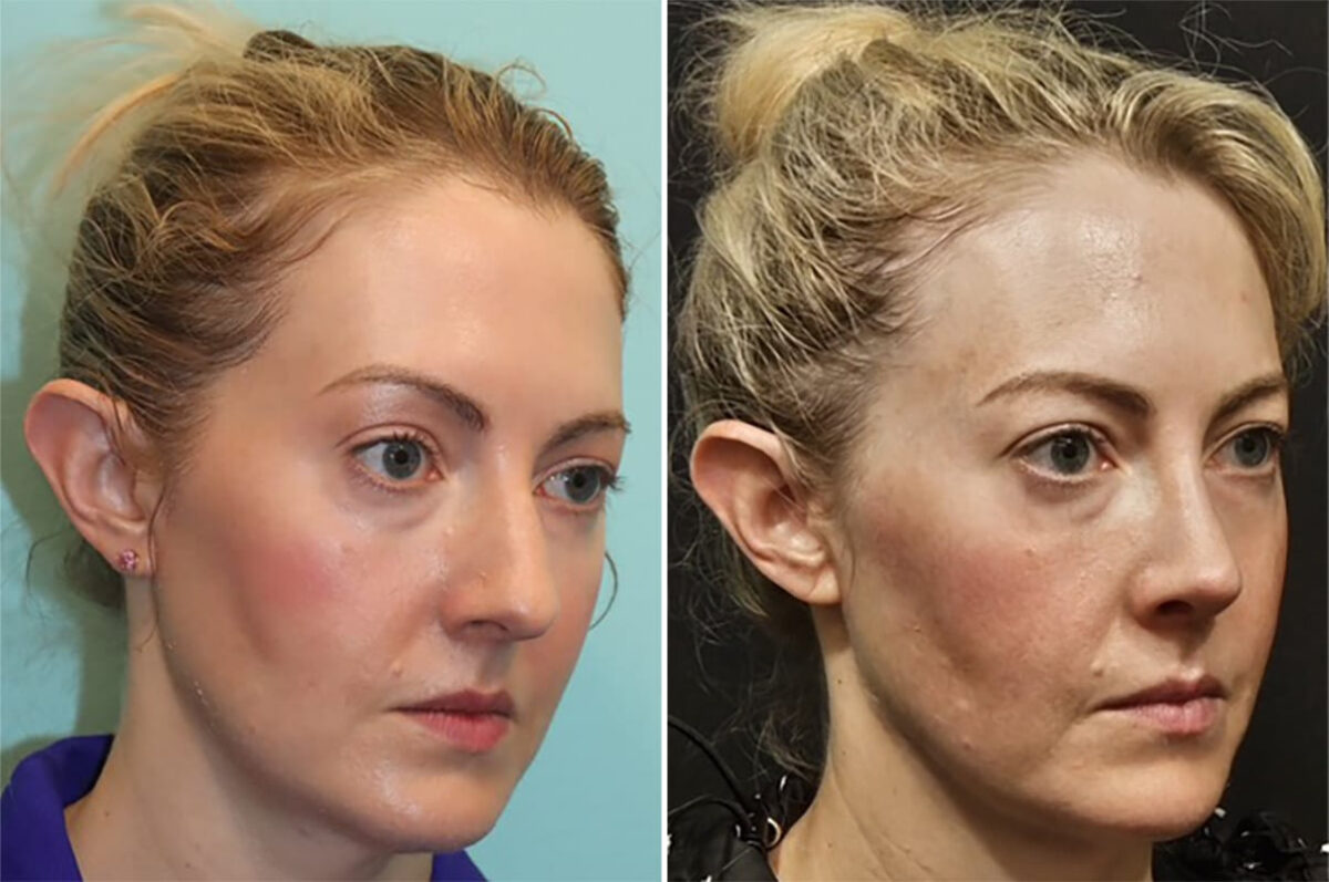 Before and after Rhinoplasty by Dr. Shervin Naderi, Patient 36771