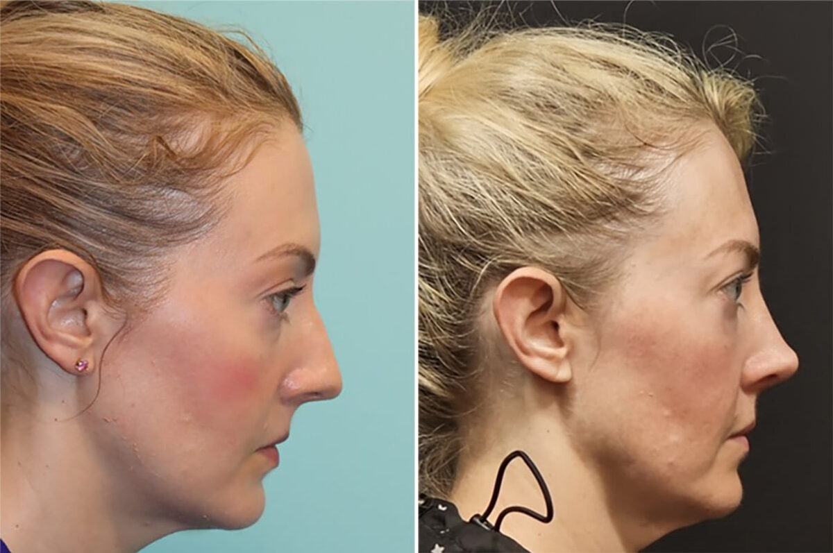 Before and after Rhinoplasty by Dr. Shervin Naderi, Patient 36771