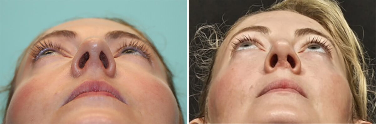 Before and after Rhinoplasty by Dr. Shervin Naderi, Patient 36771