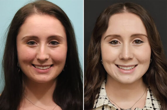 Before and after Rhinoplasty by Dr. Shervin Naderi, Patient 36780