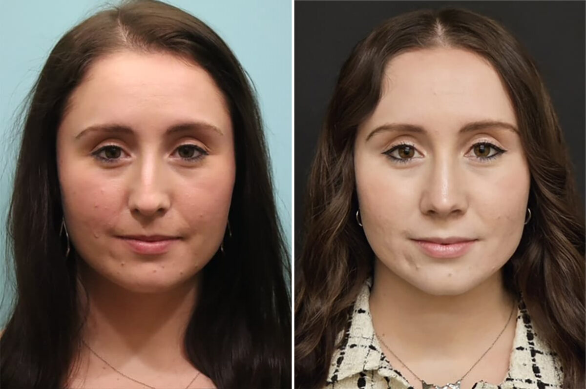 Before and after Rhinoplasty by Dr. Shervin Naderi, Patient 36780