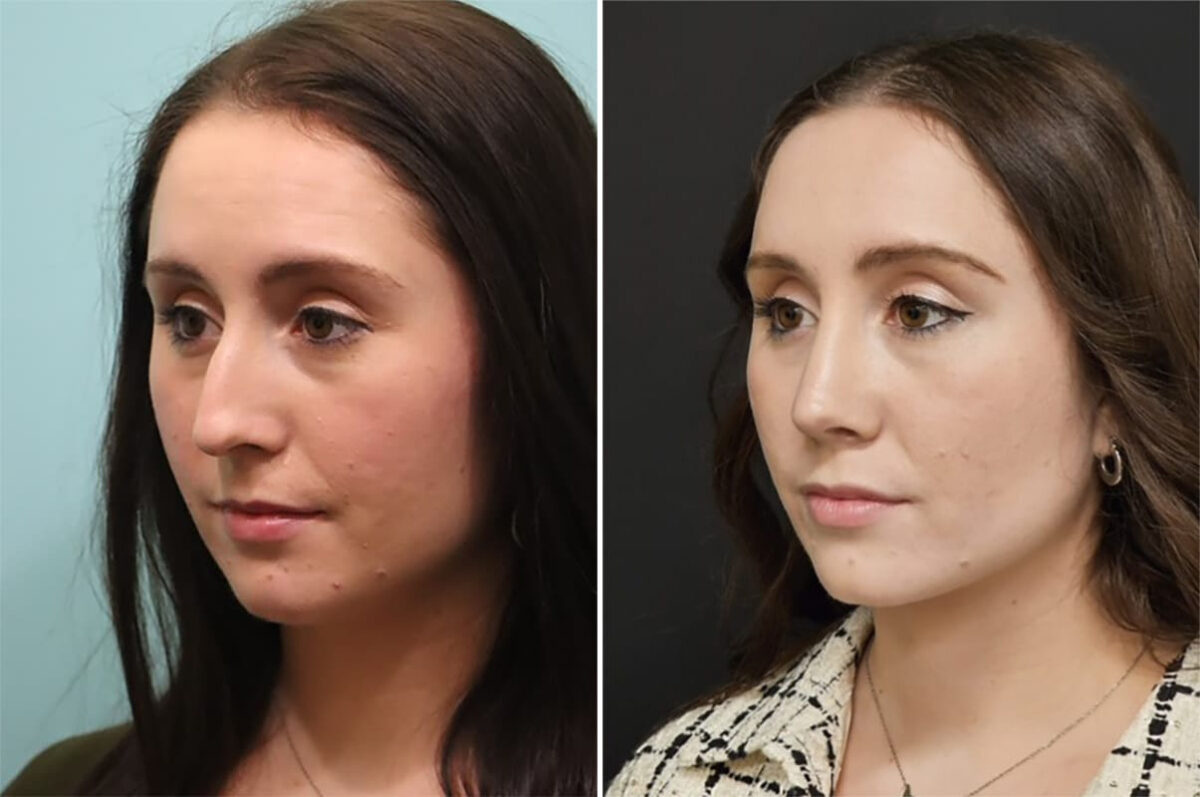 Before and after Rhinoplasty by Dr. Shervin Naderi, Patient 36780