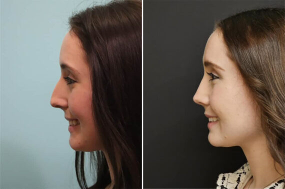 Before and after Rhinoplasty by Dr. Shervin Naderi, Patient 36780