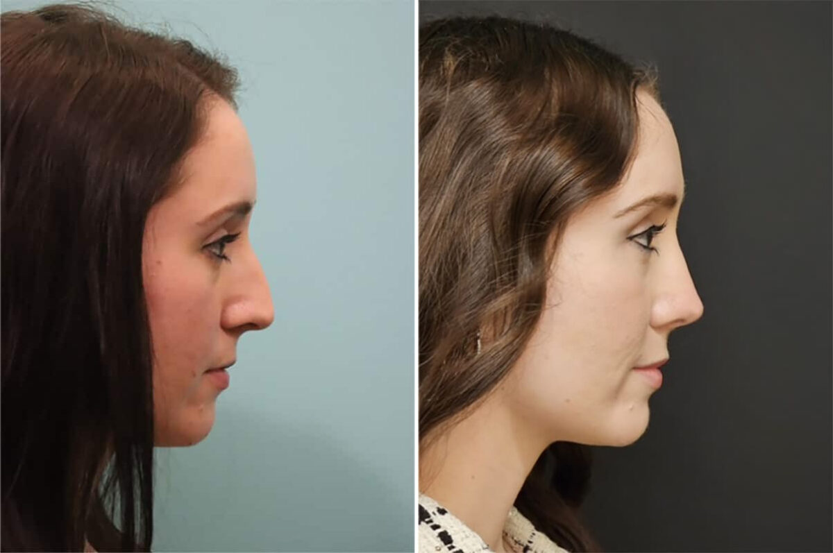 Before and after Rhinoplasty by Dr. Shervin Naderi, Patient 36780