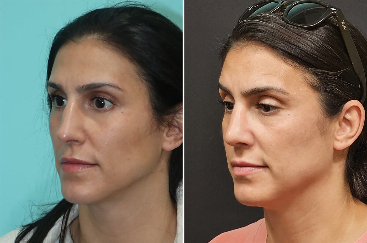 Before and after Rhinoplasty by Dr. Shervin Naderi, Patient 36843