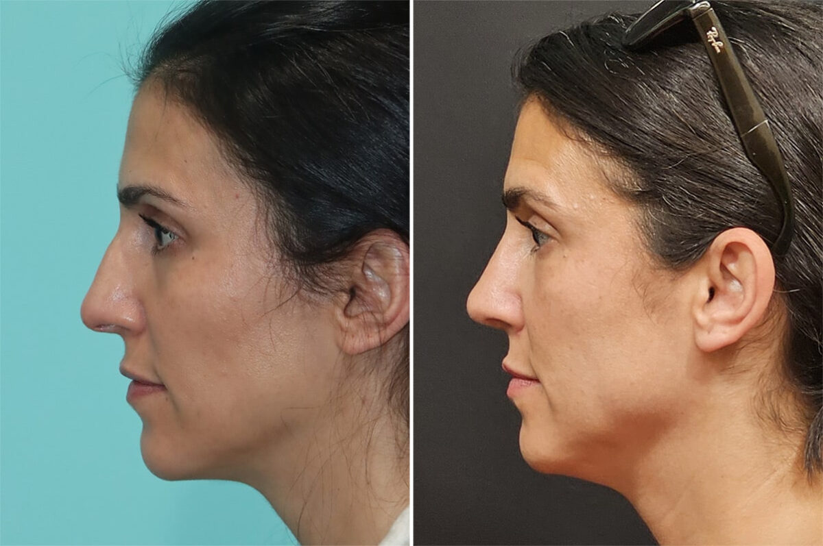 Before and after Rhinoplasty by Dr. Shervin Naderi, Patient 36843