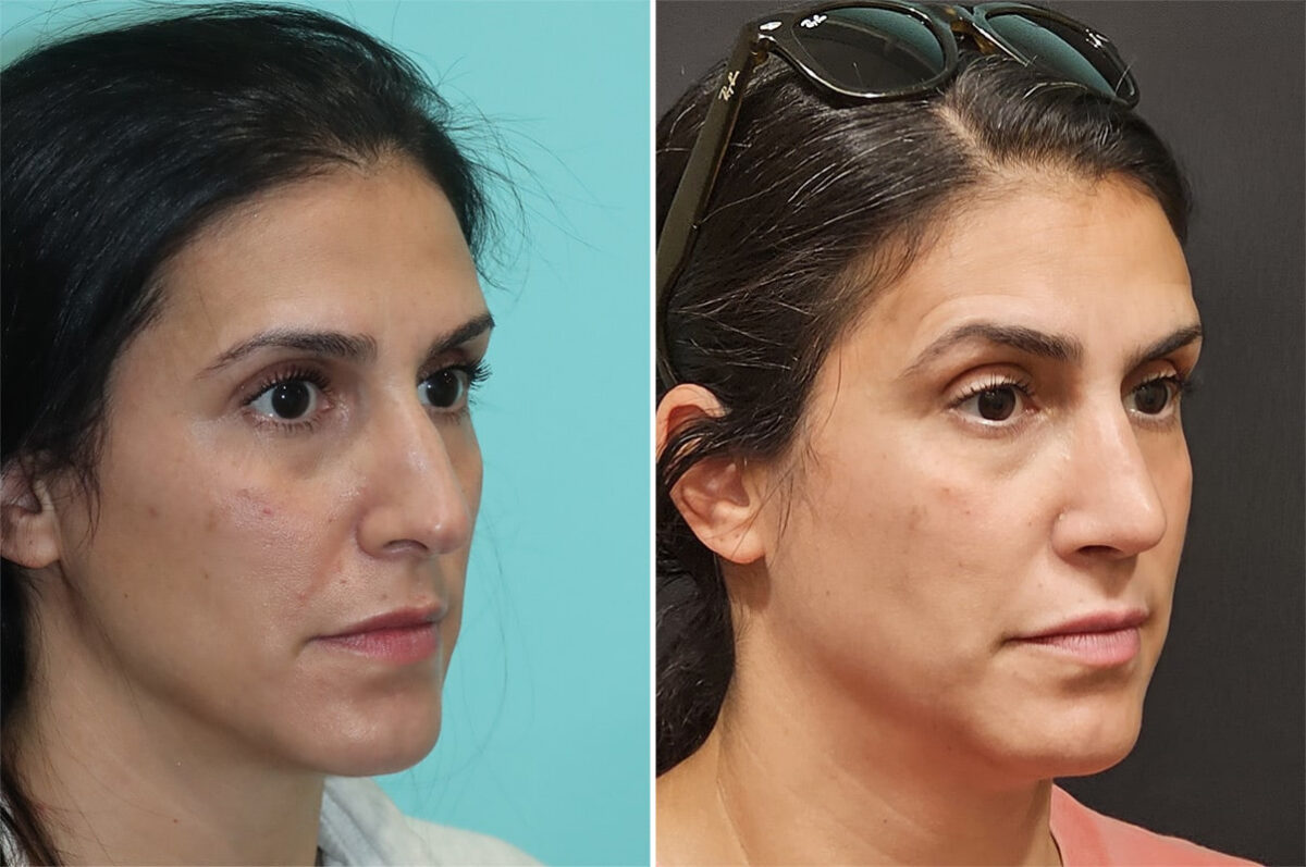 Before and after Rhinoplasty by Dr. Shervin Naderi, Patient 36843