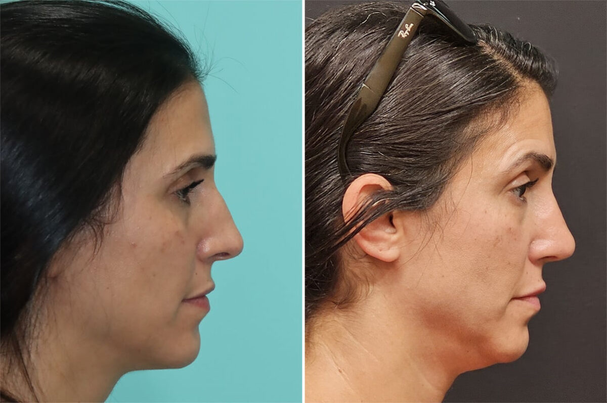 Before and after Rhinoplasty by Dr. Shervin Naderi, Patient 36843