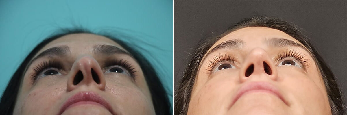 Before and after Rhinoplasty by Dr. Shervin Naderi, Patient 36843