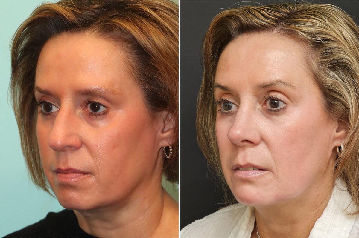 Before and after Rhinoplasty by Dr. Shervin Naderi, Patient 36851