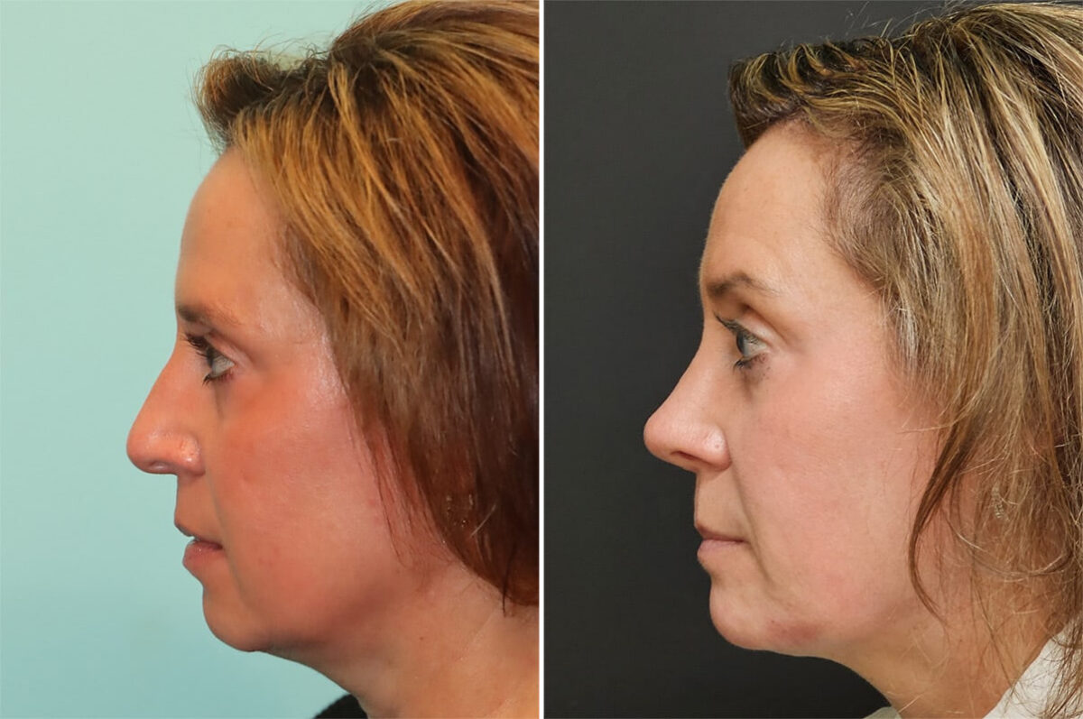 Before and after Rhinoplasty by Dr. Shervin Naderi, Patient 36851